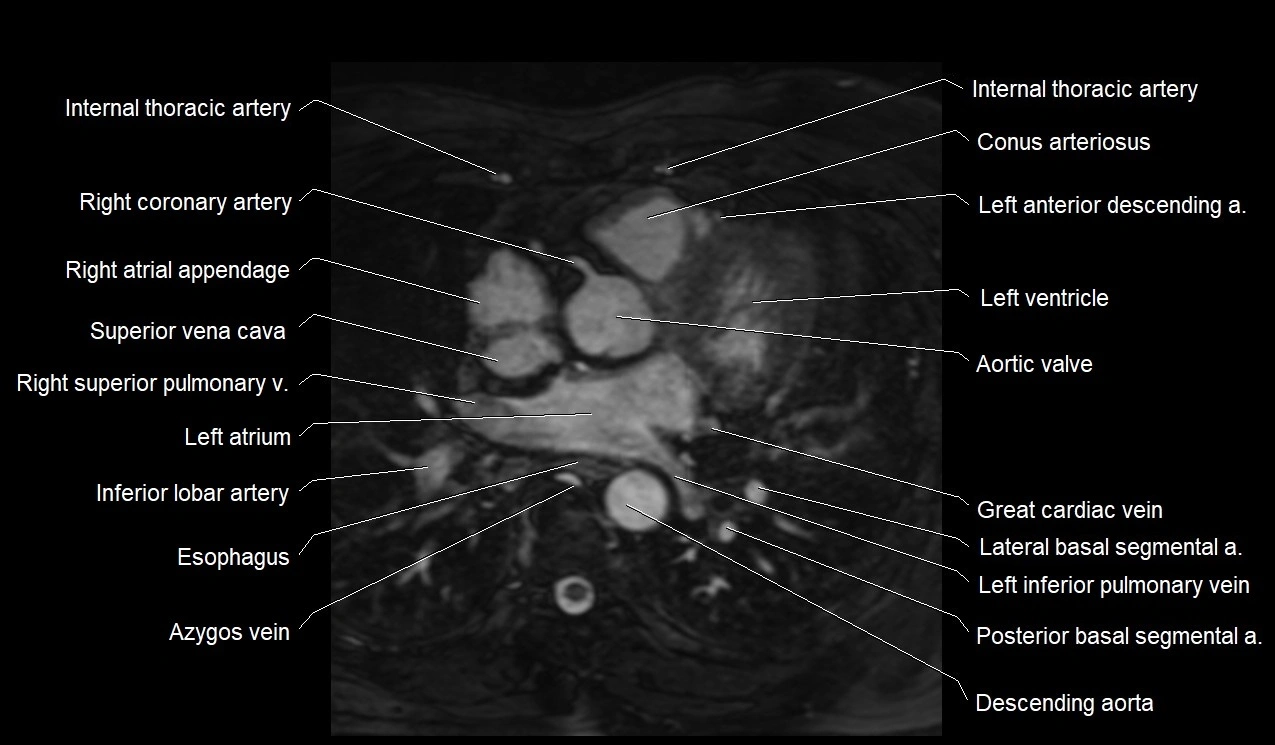 MRI heart coronary arteries and coronary veins anatomy axial image 18.webp